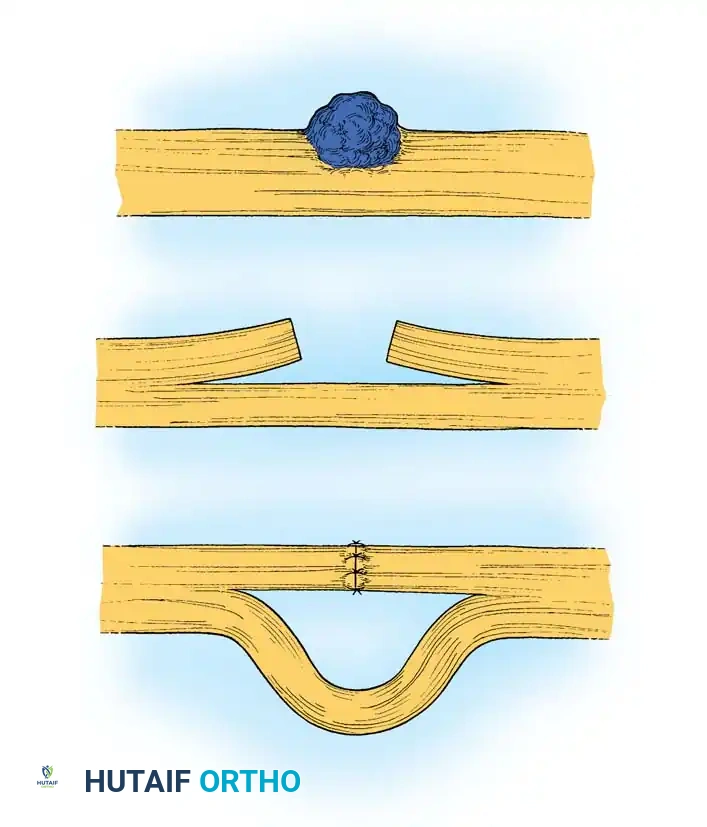 Early Management and Microsurgical Repair of Peripheral Nerve Injuries