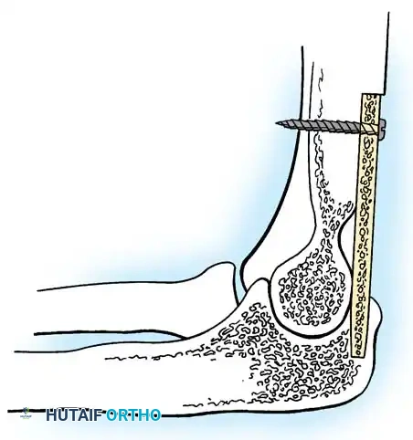 عملية دمج مفصل الكوع الدليل الشامل للمرضى