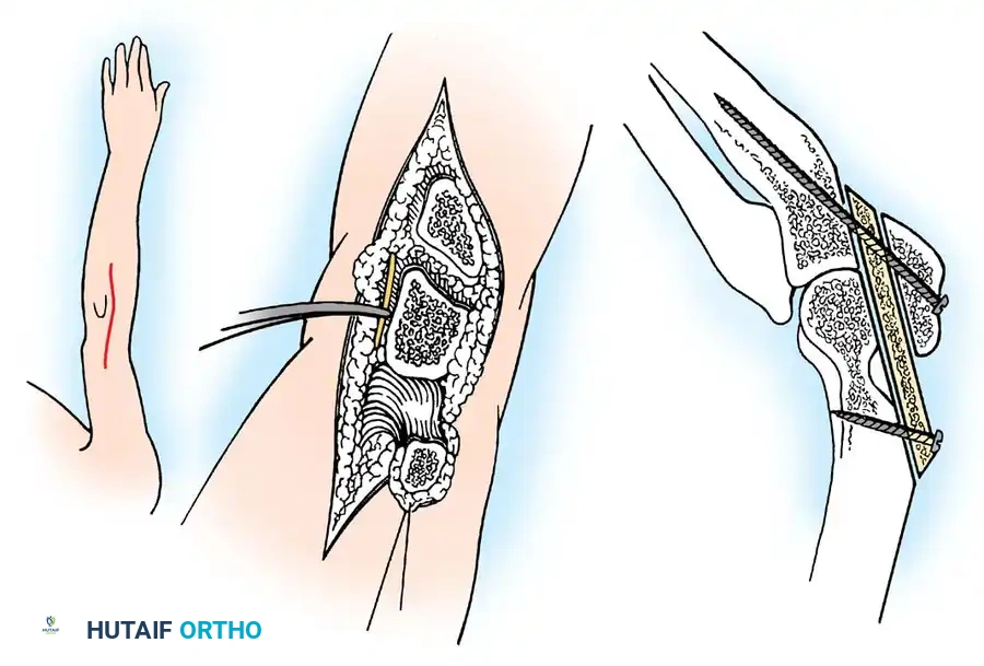 تقنية ستابلز لدمج الكوع باستخدام طعم من الحوض ومسامير