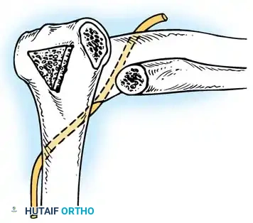 تشكيل العظام وتداخلها في تقنية أرافيلس