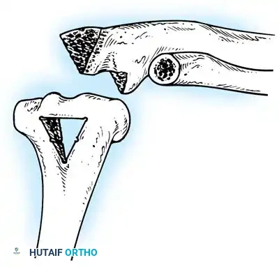 استئصال الأنسجة المصابة في تقنية أرافيلس