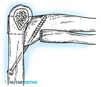 التثبيت النهائي بالمسامير في تقنية أرافيلس