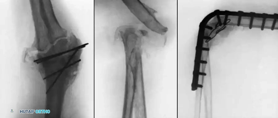 تقنية التثبيت الخارجي لدمج مفصل الكوع