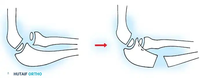Fig. 33-36 Overcorrection with posterior convexity and elongation of ulna for anterior dislocation of radial head.
