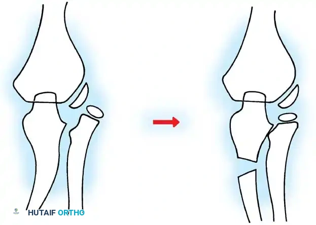 Fig. 33-37 Overcorrection with medial convexity and elongation of ulna for lateral dislocation of radial head.