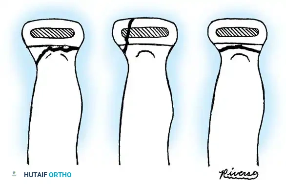 Masterclass in Pediatric Radial Head and Neck Fractures: Operative Orthopaedics