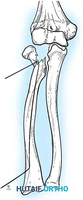 ELBOW JOINT FRACTURES AND DISLOCATIONS Surgical Diagram