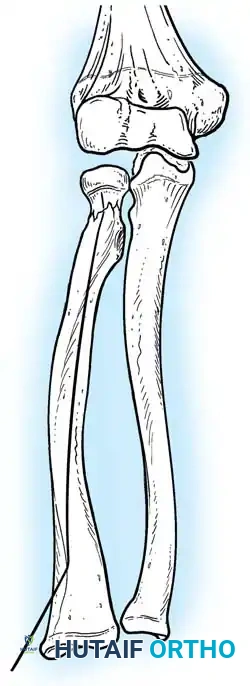 ELBOW JOINT FRACTURES AND DISLOCATIONS Surgical Diagram