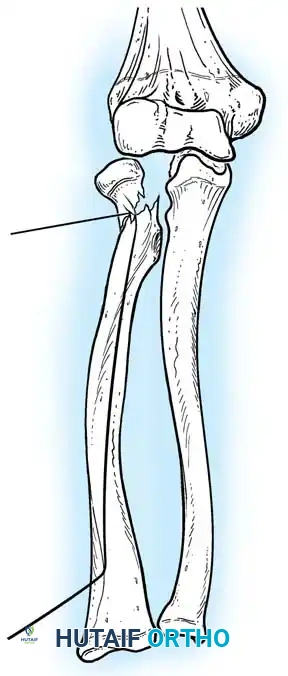 ELBOW JOINT FRACTURES AND DISLOCATIONS Surgical Diagram