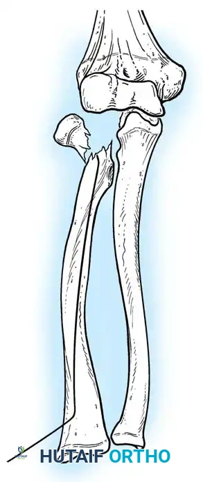 ELBOW JOINT FRACTURES AND DISLOCATIONS Surgical Diagram