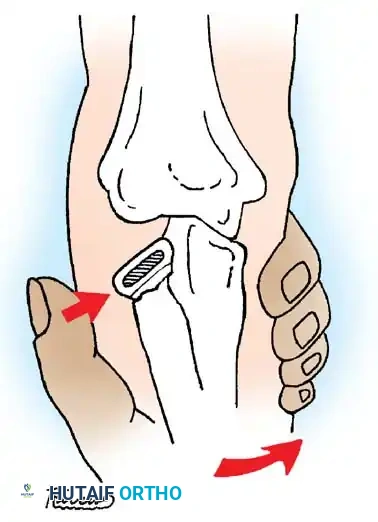 Fig. 33-45 Mechanism of reduction of radial neck fracture.