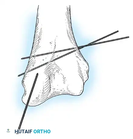 Operative Orthopaedics Clinical Reference