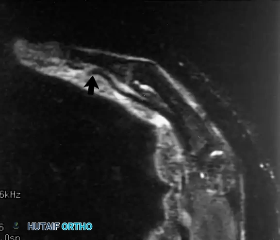 تمزق الوتر المثني العميق للأصابع وتراجعه داخل اليد