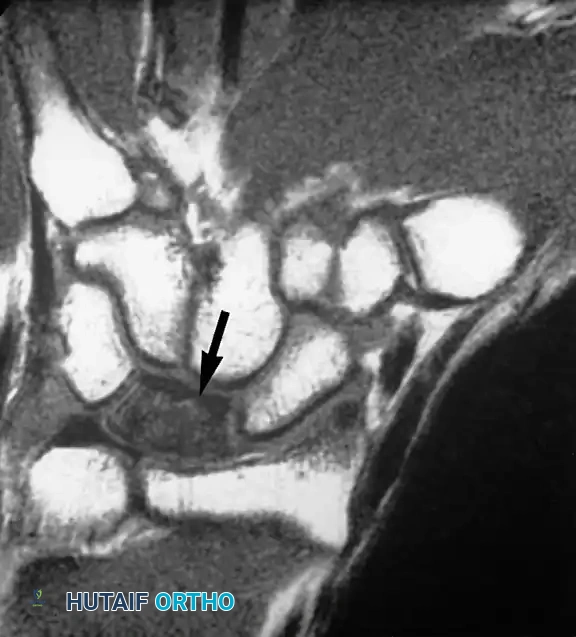 تنخر العظم الهلالي في المعصم أو ما يعرف بمرض كينبوك كما يظهر في الرنين المغناطيسي