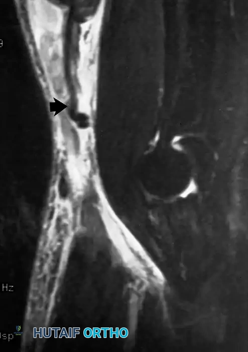 Elbow Movement: Decoding Pronation and Supination Mechanics