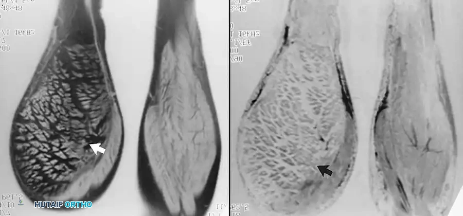 ورم شحمي عضلي في عضلة الساق يظهر بوضوح في صور الرنين المغناطيسي