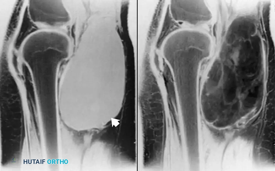 ساركوما شحمية مخاطية في الحفرة المأبضية خلف الركبة