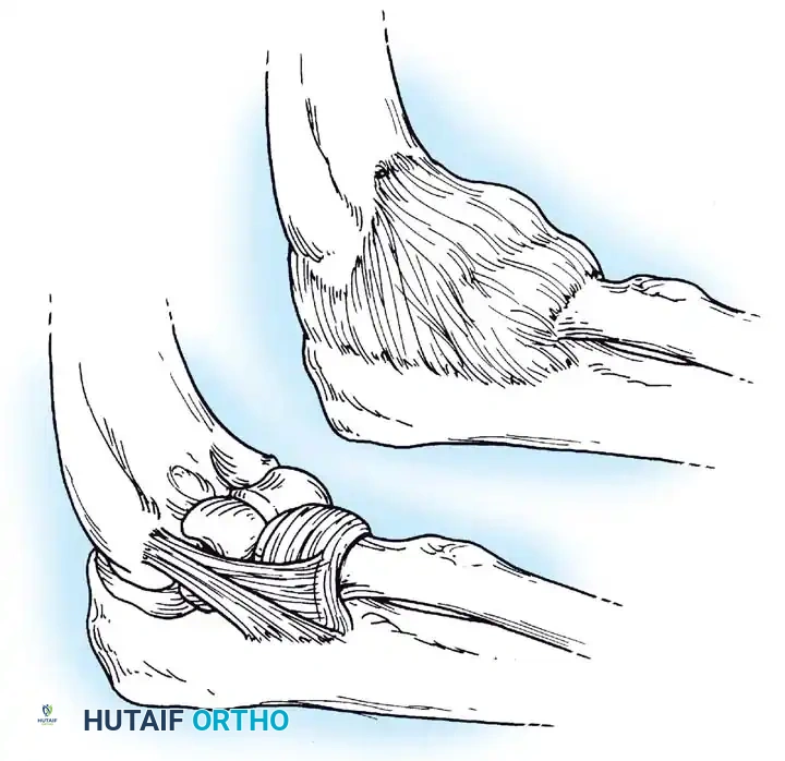 Fig. 45-61 Lateral soft-tissue structures of elbow, including ulnar and radial part of lateral collateral ligament, annular ligament, and overlying capsule. (Redrawn from McKee MD, Schemitsch EH, Sala MJ, et al: The pathoanatomy of lateral ligamentous disruption in complex elbow instability, J Shoulder Elbow Surg 12:391, 2003.)