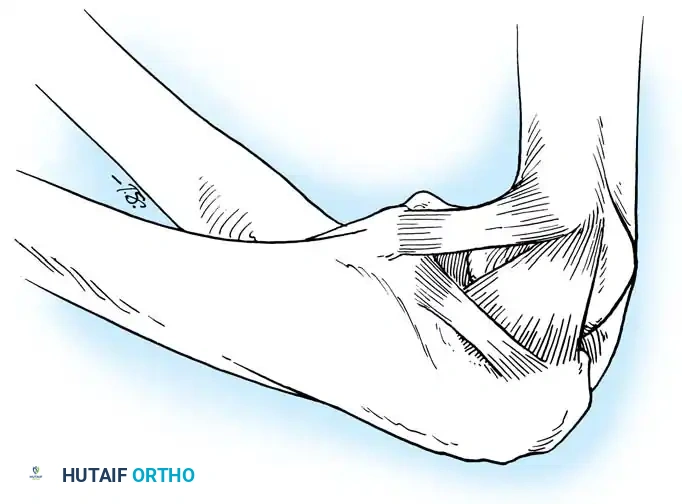 Fig. 45-62 Medial elbow ligaments. 1, anterior oblique; 2, posterior oblique; 3, transverse oblique. (From Tullos HS, Schwab G, Bennett JV, et al: Factors infl uencing elbow instability, Instr Course Lect 30:185, 1981.)