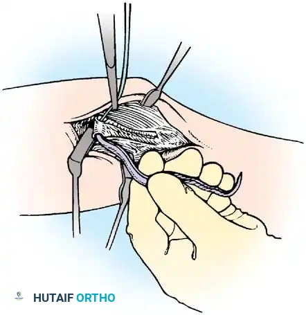 Splitting the flexor-pronator mass to expose the underlying UCL footprint.