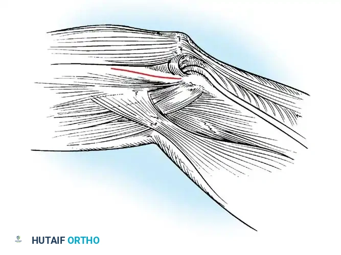 Isolation and protection of the ulnar nerve during the medial approach.