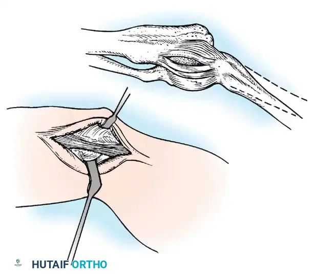 Preparation of the ulnar and humeral bone tunnels for graft passage.