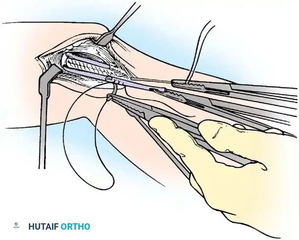 Passage of the tendon autograft through the prepared ulnar tunnels.