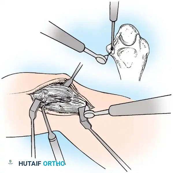 Tensioning the graft and securing it at the medial epicondyle.