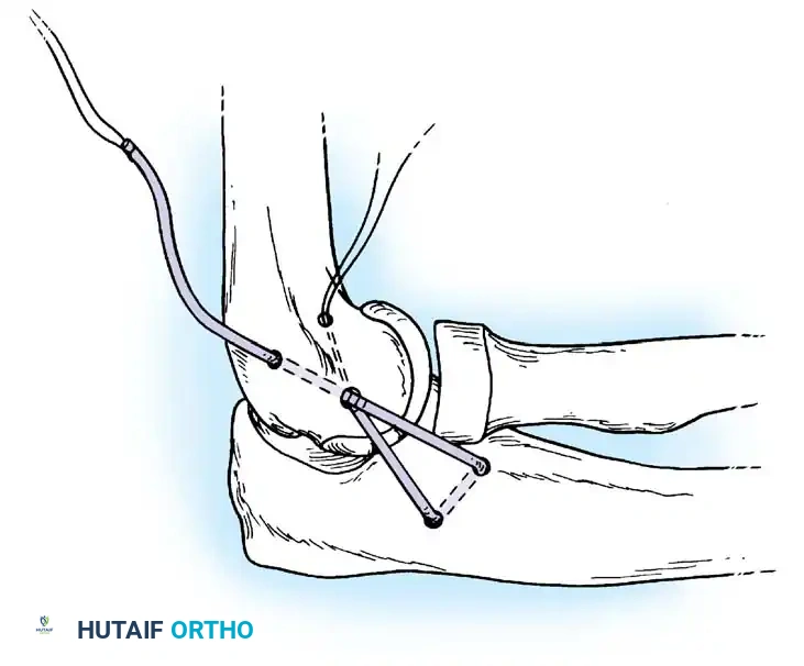 Lateral approach to the elbow demonstrating the Kocher interval.