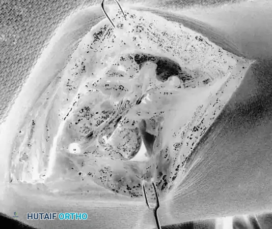 Identification of the LUCL footprint on the lateral epicondyle and supinator crest.
