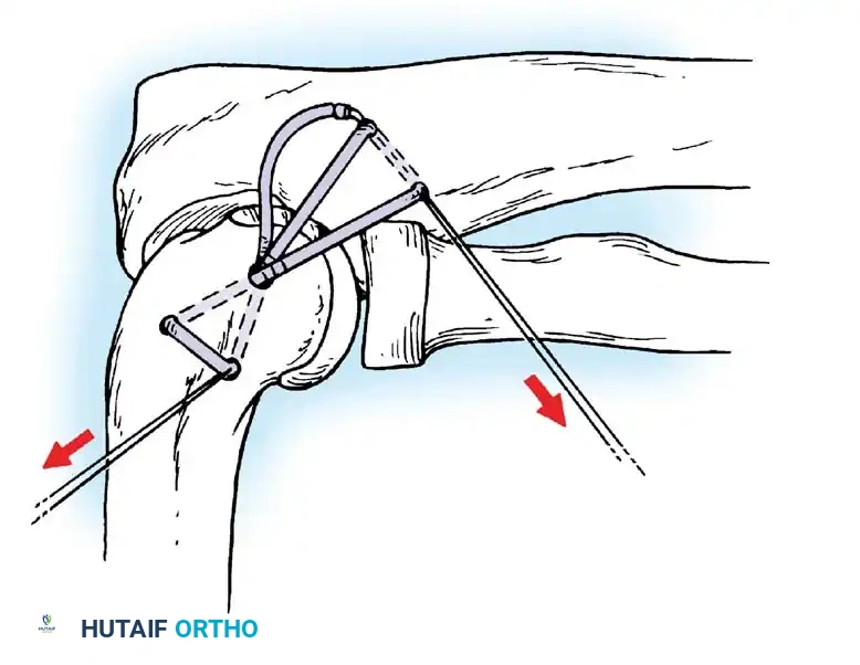Placement of suture anchors at the isometric point on the lateral epicondyle.