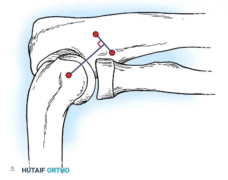 Final construct of the LUCL reconstruction demonstrating restored lateral stability.