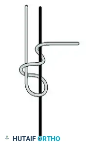 ELBOW Surgical Diagram