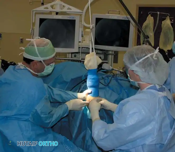 Fig. 49-58 Operating room setup for patient in supine position with elbow maintained at 90 degrees of fl exion and 90 degrees of shoulder abduction by overhead traction through sterile stockinette. Surgeon with sterile drape around waist and sitting comfortably with television screen placed directly across table.