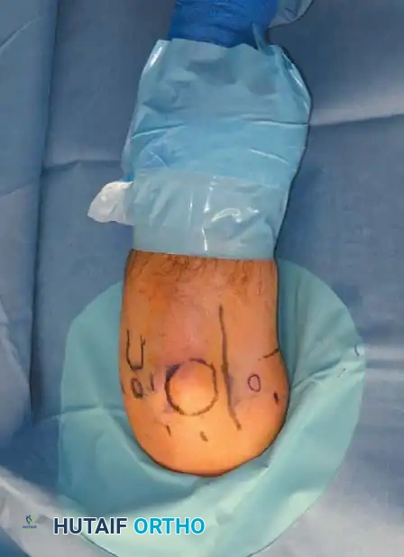 Fig. 49-60 B, Operating room setup for elbow arthroscopy with patient prone.