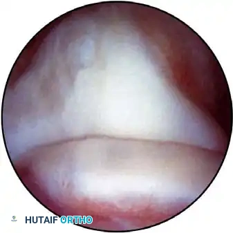 Anteromedial portal anatomy