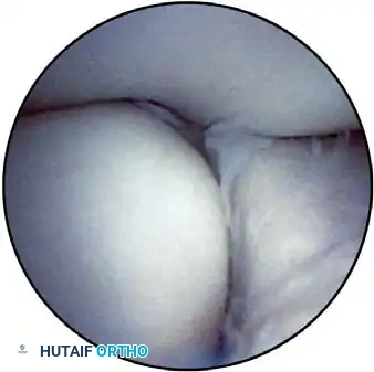 Final portal closure/dressing