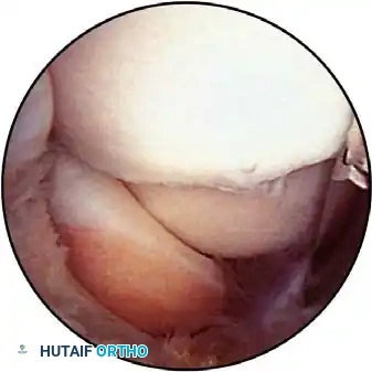 Joint distention technique