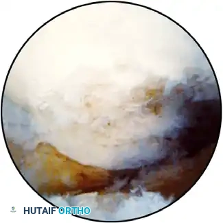 Osteophyte resection