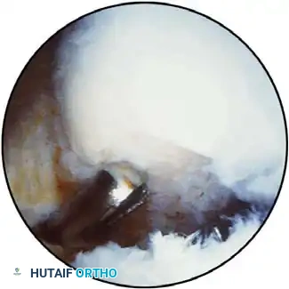 Osteochondral defect evaluation