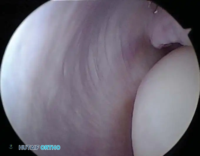 Debridement of adhesions