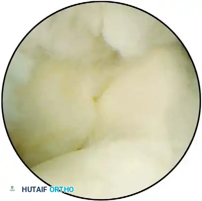 Lateral decubitus setup