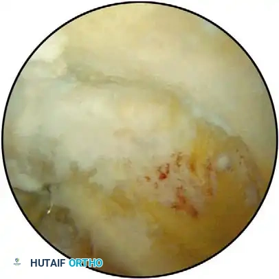Supine arthroscopy setup detail