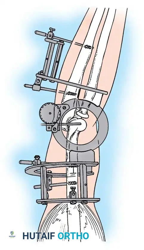 Hutaifortho's Orthopaedic Diagram