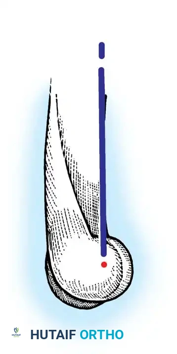 Fig. 8-34 Axis of rotation of elbow in fl exion and extension is through center of trochlea, colinear with distal anterior cortex of humerus.