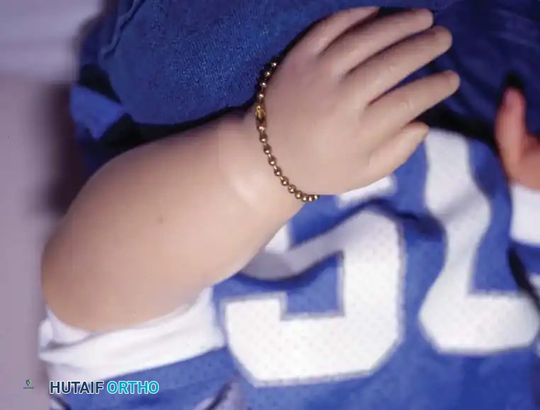 Fig. 76-3 A and B, Early fi tting of passive prosthesis in child with congenital forearm amputation may encourage use of prosthesis.