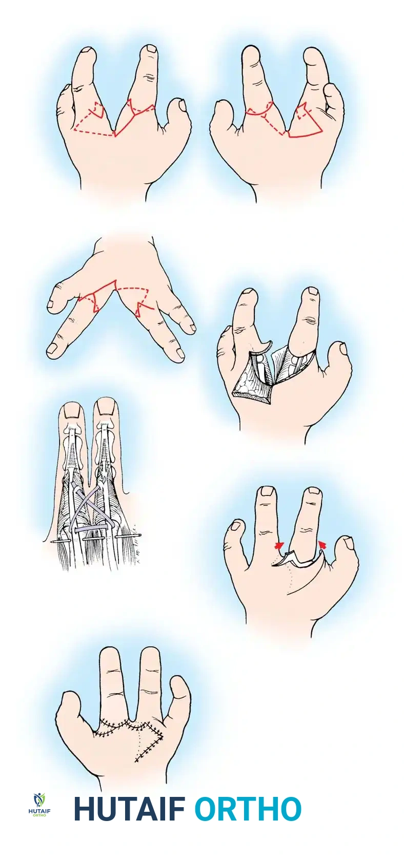 Hutaifortho's Orthopaedic Diagram