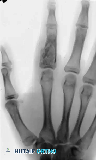 ENCHONDROMA Surgical Diagram