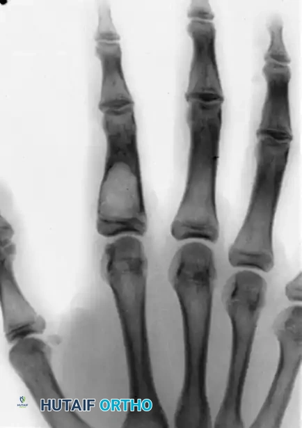 ENCHONDROMA Surgical Diagram