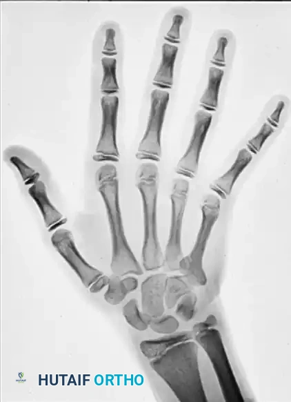 ENCHONDROMA Surgical Diagram